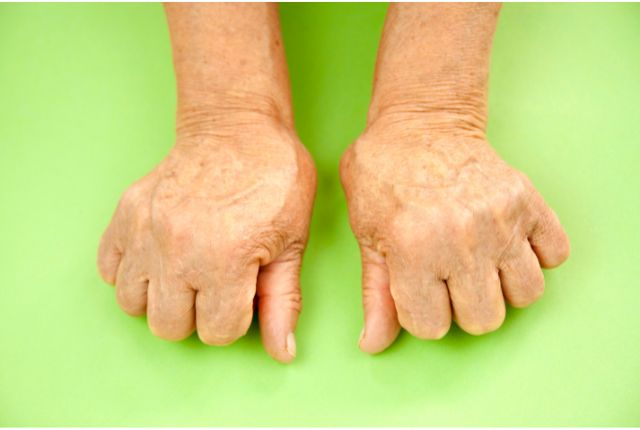 Polyarthrite rhumatoïde