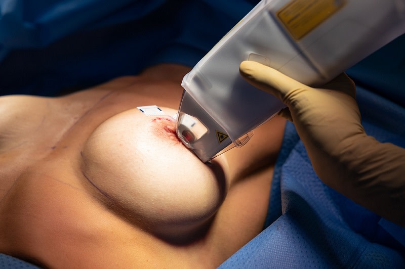 Urgotouch, un laser destiné à atténuer la cicatrisation post-opératoire