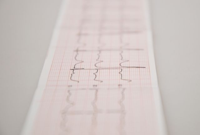 arythmie-cardiaque-1-elsan-2022