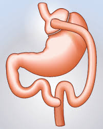 Chirurgie obésité bypass - CHP Brest - Keraudren