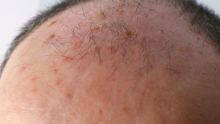 Le soleil est-il la seule cause du cancer de la peau ? Image d'une kératose actinique, signe d'une trop longue exposition au soleil. Lésions rouges et croûteuses.