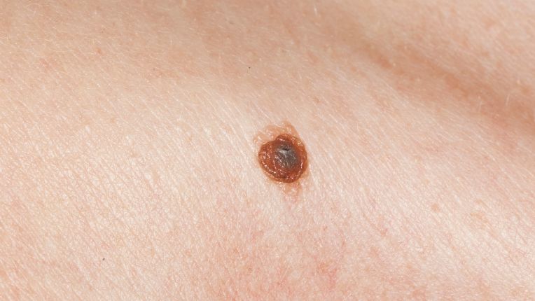 Le soleil est-il la seule cause du cancer de la peau ? Image d'un grain de beauté suspect, bombé, aux contours inégaux, de couleur noir, marron, rouge...