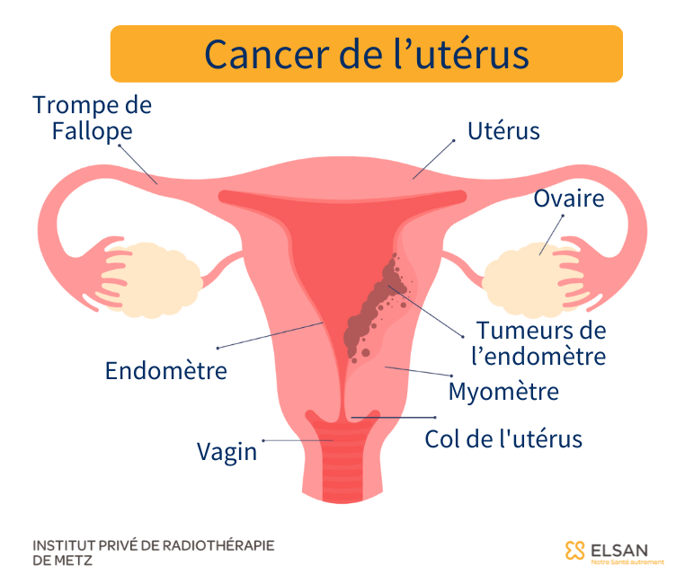 cancer uterus endometre