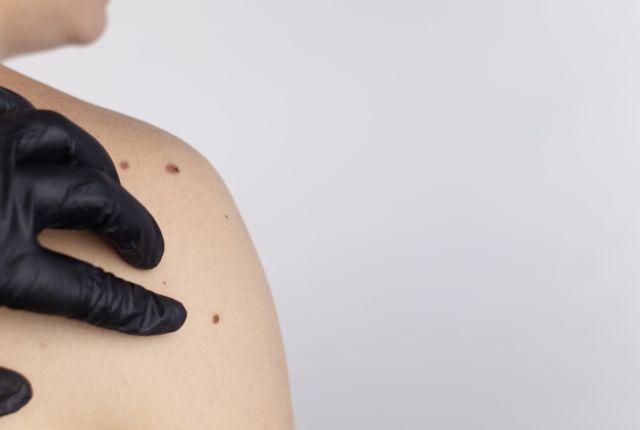 Carcinome épidermoïde : définition, pronostic, photo. Main de soignant gantée inspectant des grains de beauté sur l'épaule d'une personne.