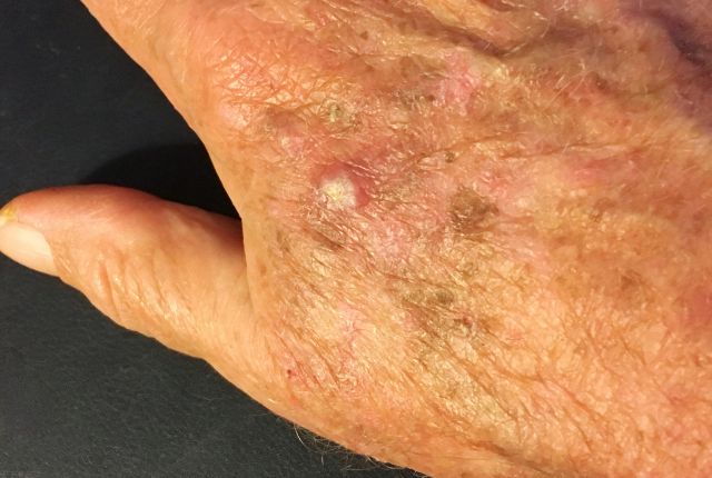 Carcinome épidermoïde : définition, pronostic, photo :Photo d'une Kératose actinique - précurseur du cancer épidermoïde de la peau, sur une main.
