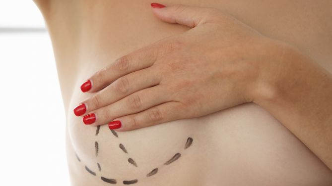 Chirurgie esthétique : une belle reconstruction du sein : une femme masque avec sa main son sein, sur lequel le chirurgien a réalisé un tracé.