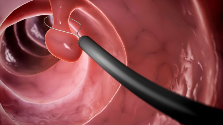 Combien de temps met un polype pour devenir cancéreux ? Image de synthèse où l'on voit un polype en train d'être extrait.