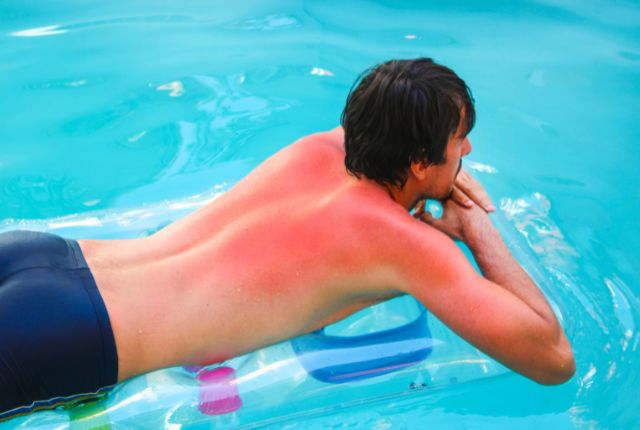 Coup de soleil : un homme dans une piscine avec le dos rougi par le soleil.