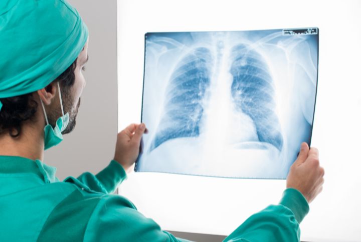 Dépistage du cancer du poumon : un chirurgien analyse une radiographie des poumons.