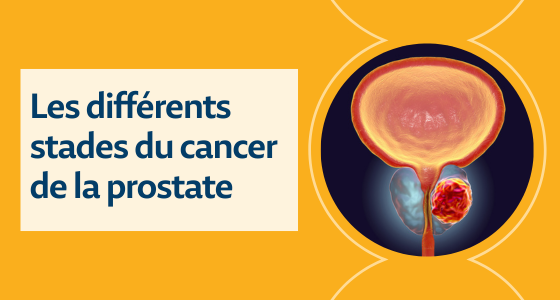 Cancer prostate stade