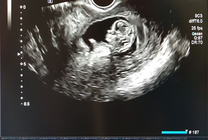 Echographie 1er trimestre : image d'un embryon de 12 semaines.