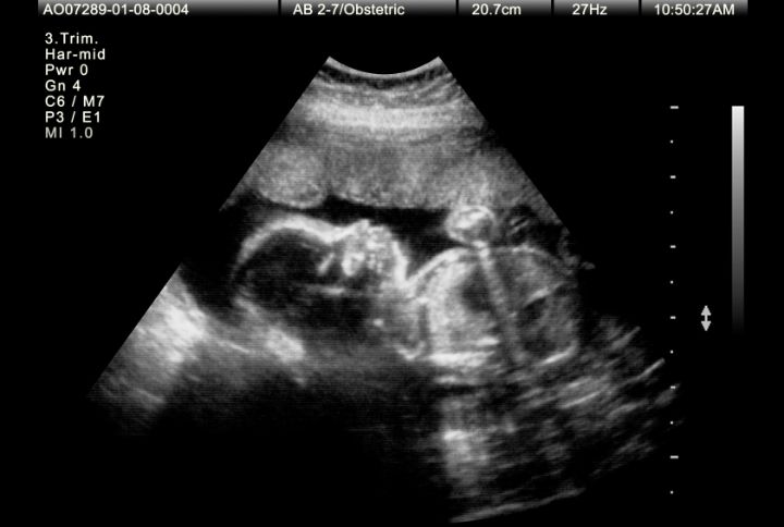 Echographie du 3e trimestre : image d'un foetus lors de la 3e échographie.