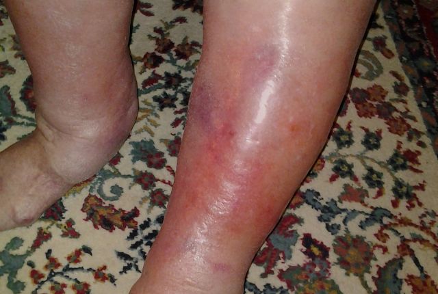 Erysipèle sur une jambe rouge et enflée.