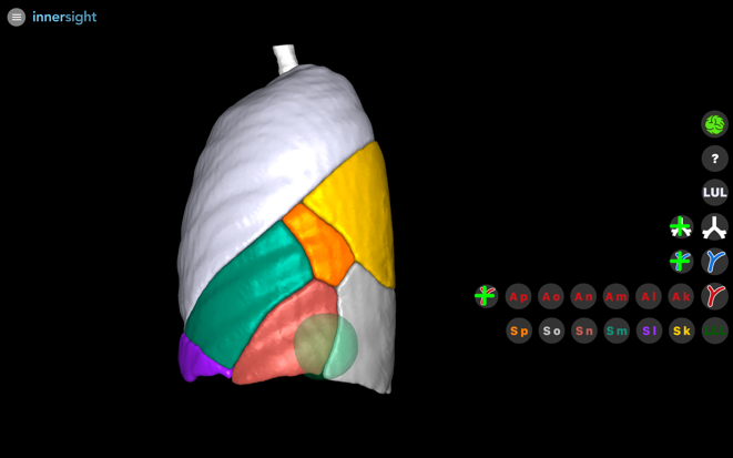 Reconstruction 3D. Détermination du type de segmentectomie à réaliser