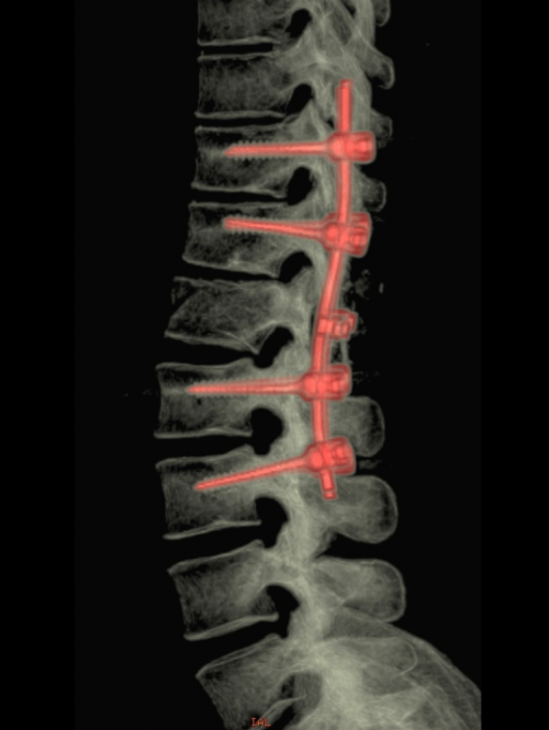 osteosynthese classique a ciel ouvert