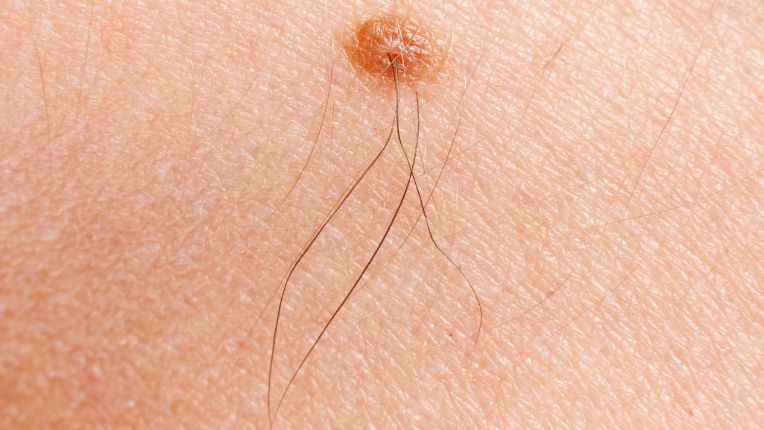 Grain de beauté et cancer : comment savoir si un grain de beauté est dangereux ? Mélanome. Grain de beauté irrégulier sur la peau bombé et de couleur beige pâle.