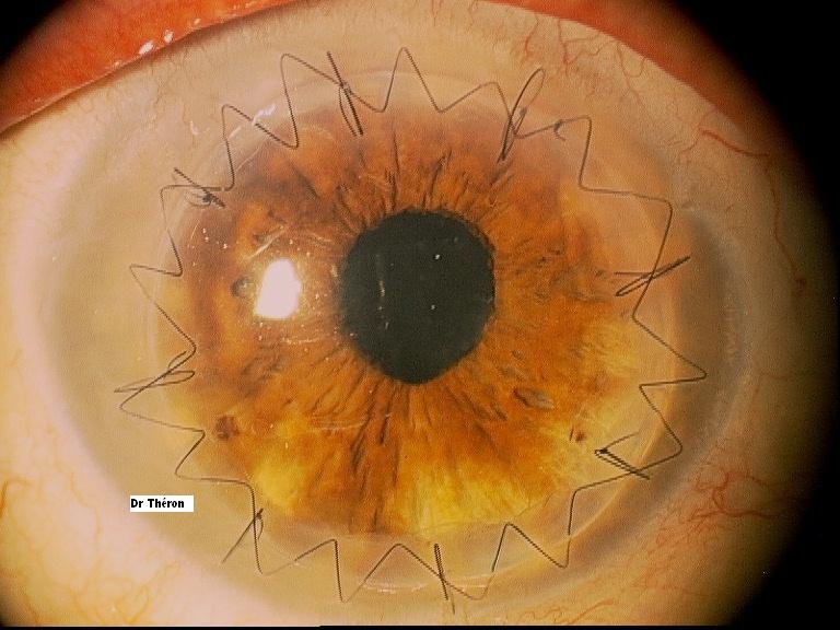 Greffe de cornée : image d'un oeil et d'une cornée