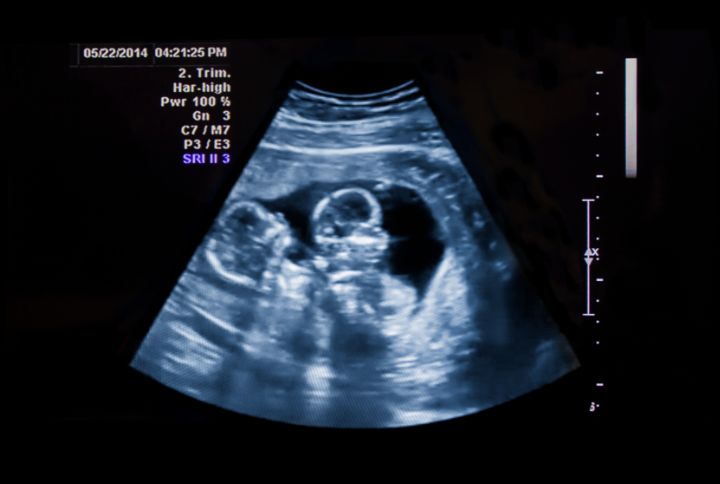 Grossesse gémellaire : échographie du 2e trimestre laissant apparaître deux fœtus .
