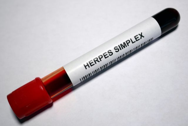 Flacon de prélèvement sanguin dans le cadre d'une recherche du virus de l'herpès. L’herpès génital est une infection sexuellement transmissible.