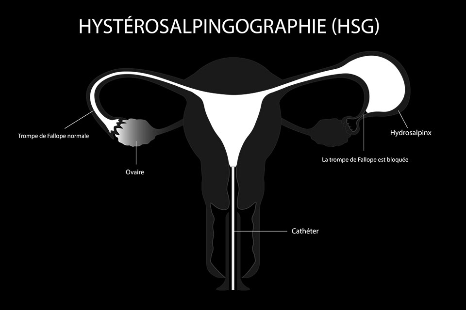 hysterosalpingographie