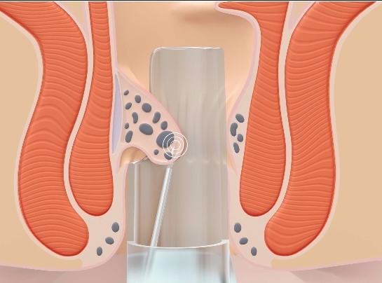 service chirurgie vasculaire hpnl nancy