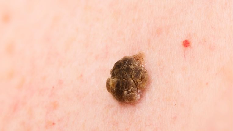 Vue de près d'une kératose séborrhéique : petite lésion de couleur brun clair à brun foncé, avec une apparence squameuse, agglomération de cellules mortes qui forment des excroissances.