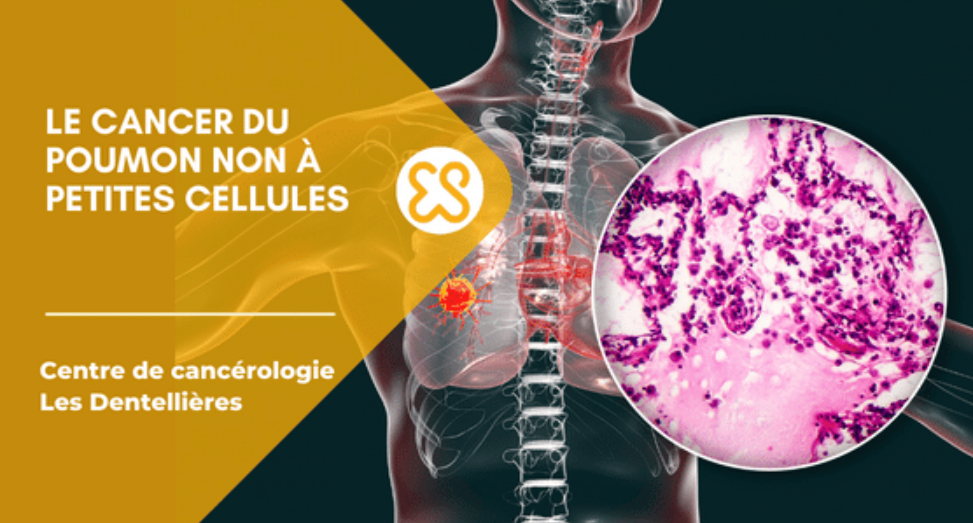 cancer poumon CPNPC