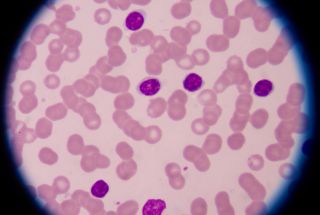 Leucémie lymphocytaire chronique c’est quoi ? Image de cellules dans le cadre d'une leucémie lymphocytaire chronique.