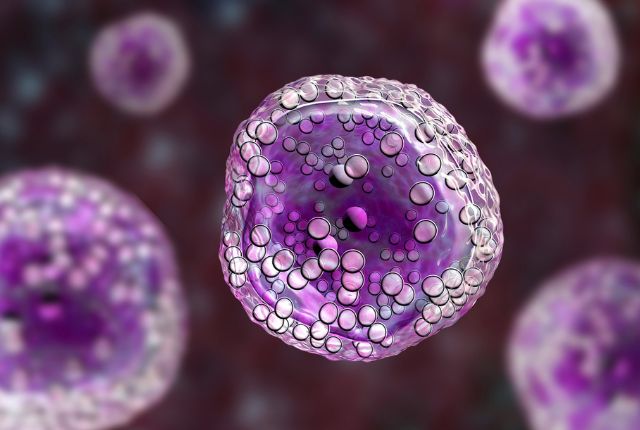 Lymphome : image de cellules cancéreuses du lymphome de Burkitt.