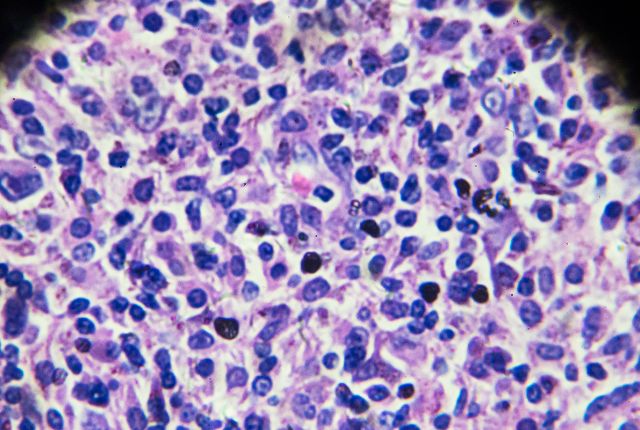 Lymphome non hodgkinien : définition et taux de guérison. Cellules d'un lymphome non hodgkinien vues au microscope.