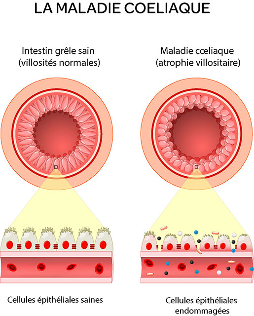 maladie coeliaque schéma