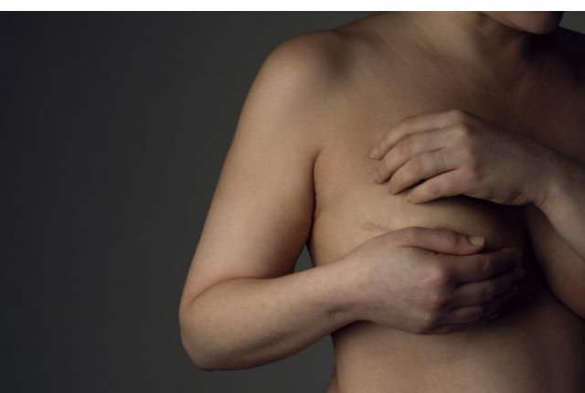 Femme tenant son sein à moitié caché par sa main, à la suite d'une mastectomie.