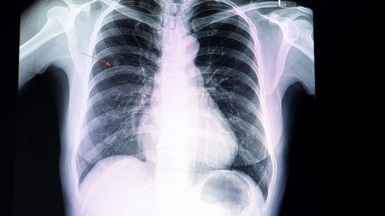 Nodule : définition et lien avec le cancer.. Image d'un petit nodule sur la radiographie d'un patient. Une flèche rouge pointe vers la minuscule masse.