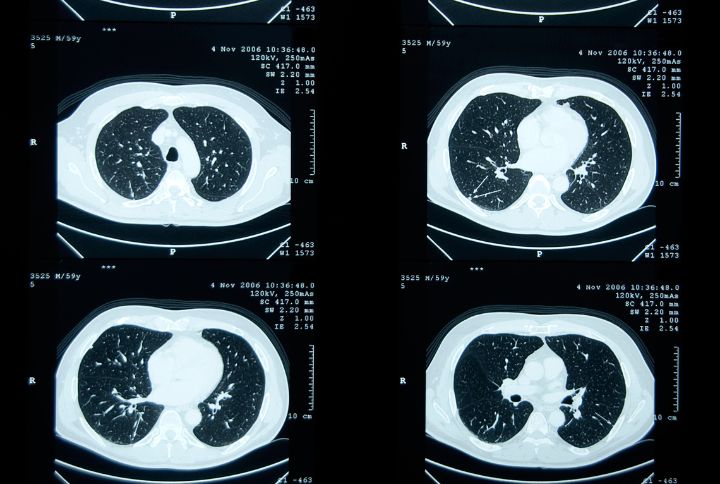 nodule pulmonaire : définition, symptômes, scanner. Images ou taches de nodules sur des clichés de scanner.