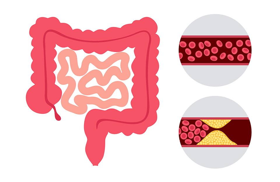 occlusion intestinale representation