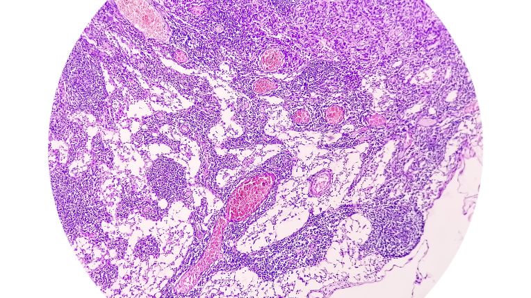 Opération de l’adénocarcinome par robot à Montauban. Image au microscope d'un adénocarcinome de l'estomac.
