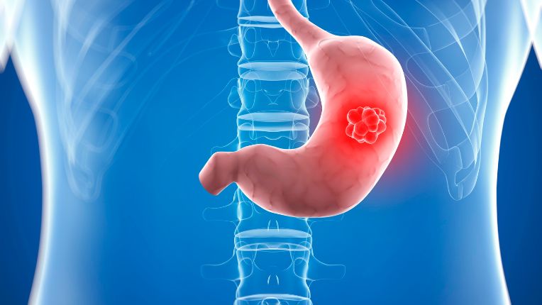 Opération de l'estomac par robot à Agen. Image de synthèse en 3D figurant une tumeur dans un estomac.