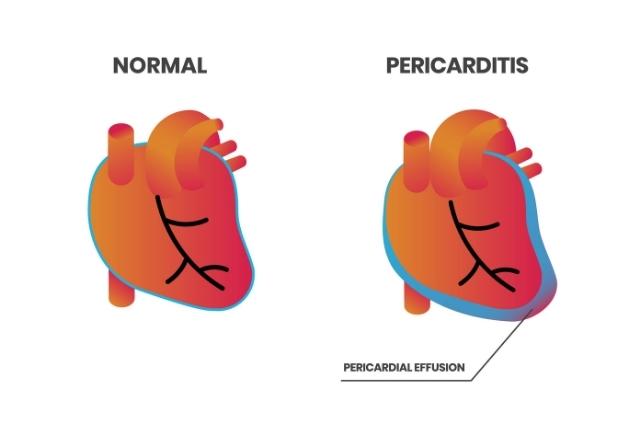 pericardite