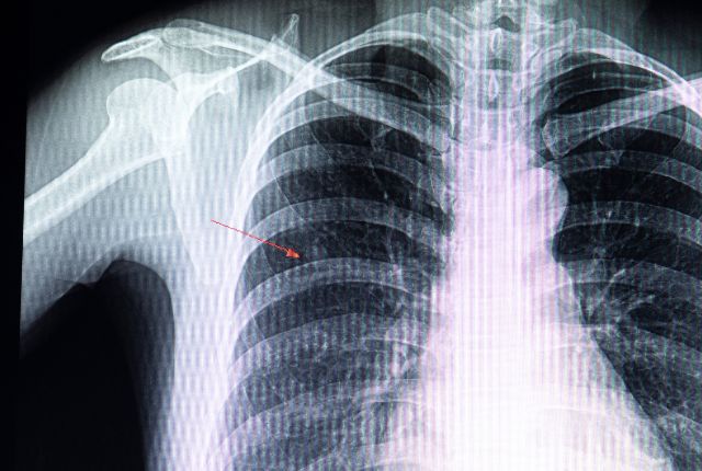 Peut-on vivre avec des nodules aux poumons ? Photo issue d'une imagerie médicale montrant en haut à gauche une tache : il s'agit d'un petit nodule.