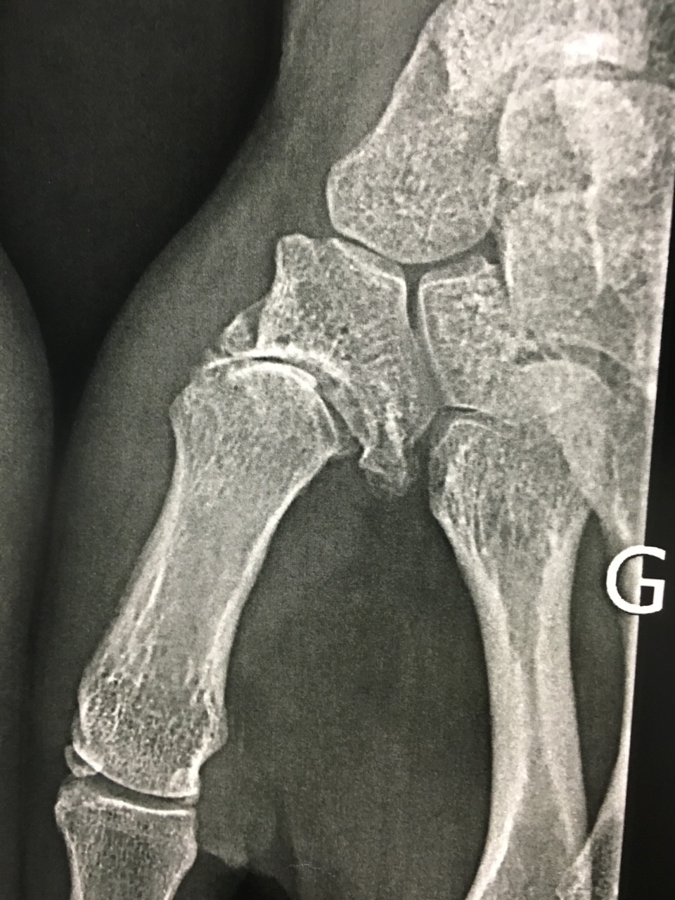 Rhizarthrose, l’arthrose du pouce2