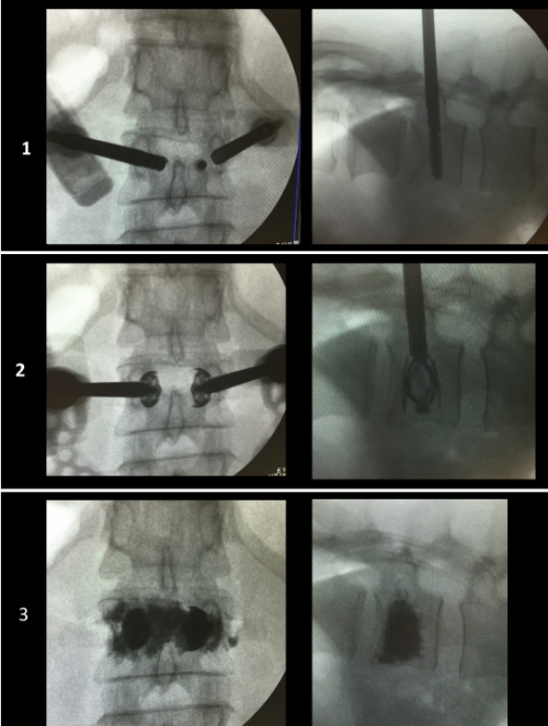 procédure d'expansion vertébrale type spinejack