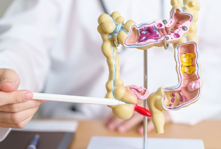 Diverticulose colique : quels liens avec la diverticulite ou sigmoïdite ? Un médecin montre un modèle en plastique figurant les intestins.