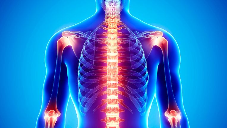 Quel est le cancer le plus douloureux ? Image de synthèse montrant le haut d'un corps humain avec des points douloureux figurés par une couleur jaune vive.