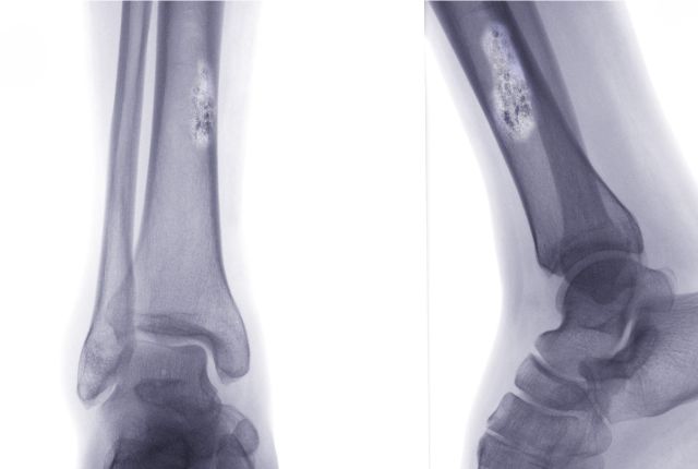 Quel examen pour détecter un cancer des os ? Image d'une radiographie des tibias montrant un cancer des os..