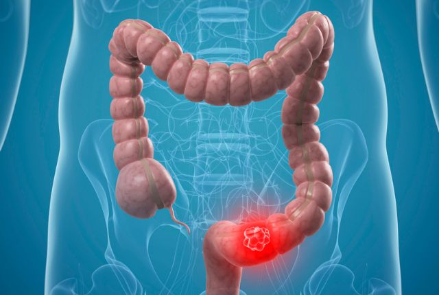 Quels sont les premiers symptômes du cancer du colon ? Image de synthèse d'un côlon où la zone cancéreuse est figurée par un point rouge.