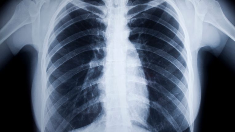 Différence entre radio et scanner ? On voit sur un écran les images obtenues d'un scanner, en plusieurs dimensions. Image typique d'une radiographie des poumons.