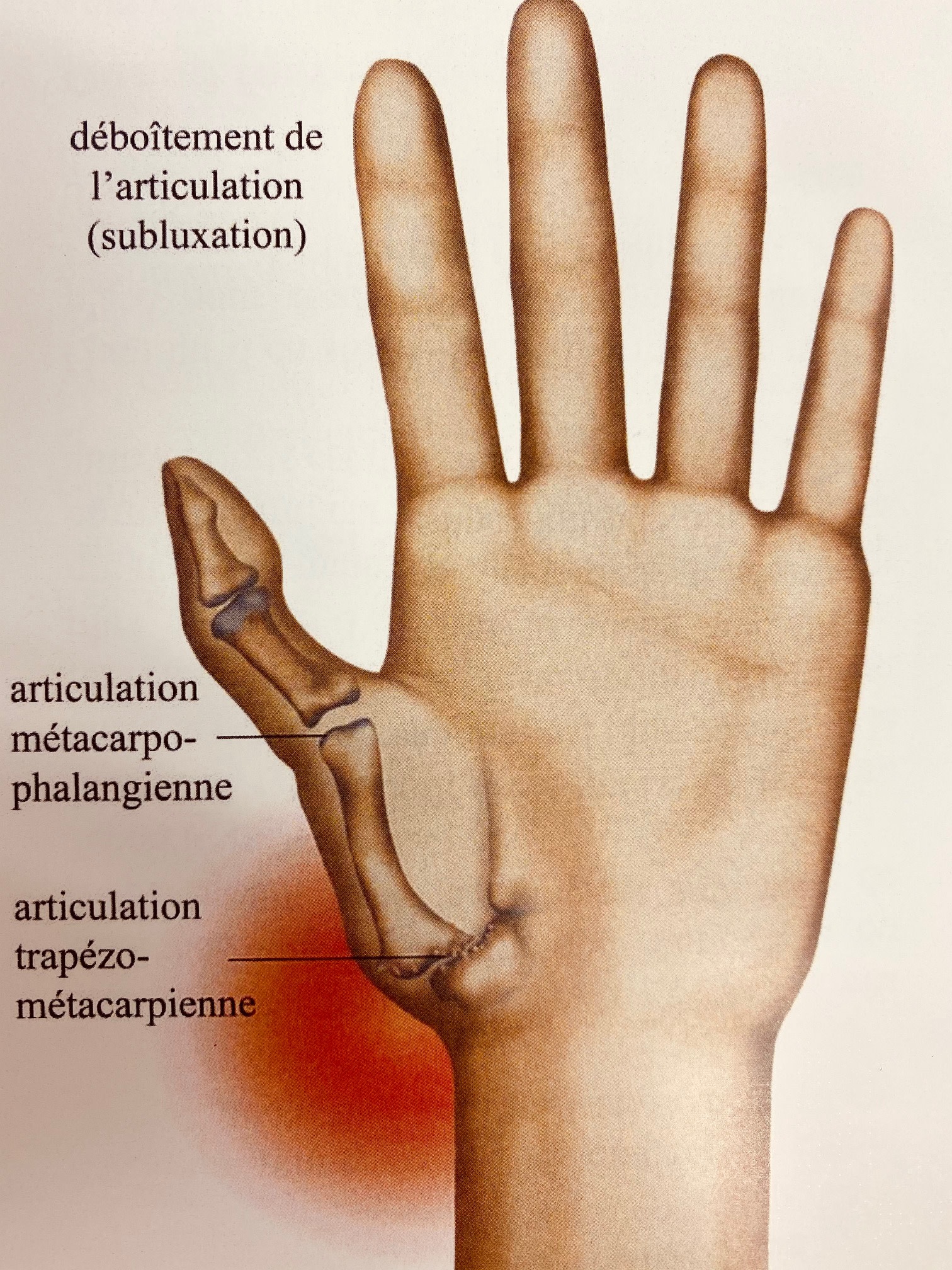 Rhizarthrose, l’arthrose du pouce