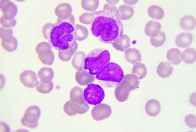Taux de survie  de la leucémie aiguë myéloïde (LAM) : image de cellules cancéreuses.