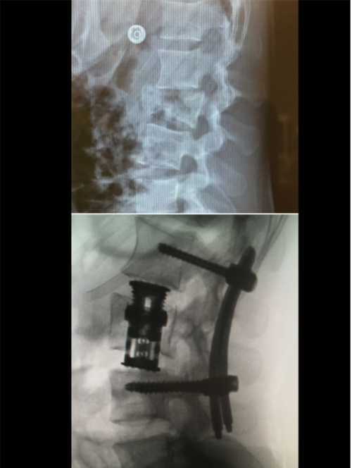 association techniques pour une fracture complexe