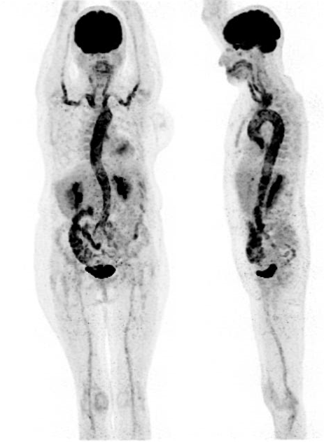 TEP AU 18F, SIM, Strasbourg Imagerie Moléculaire